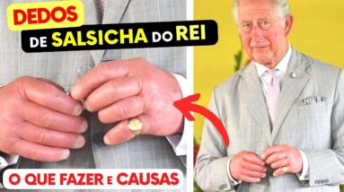 MÃOS INCHADAS do Rei! CAUSAS e o O QUE FAZER (Mãos de Salsicha!)