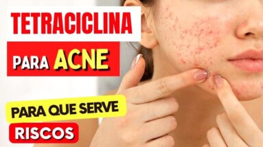 TETRACICLINA PARA ACNE e mais - O que você PRECISA SABER! Como Tomar, Riscos e Para Que Serve