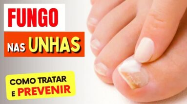 Como TRATAR e PREVENIR o FUNGO NAS UNHAS - Naturalmente!