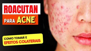 ROACUTAN PARA ACNE e mais - O que você PRECISA SABER! Como Tomar, Riscos e Para Que Serve