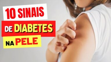 10 Principais SINAIS de DIABETES na PELE! (Sintomas de AÇÚCAR NO SANGUE)