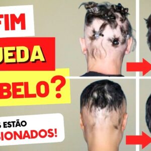 BARICITINIBE - É O FIM DA QUEDA DE CABELO? Por que os Médicos estão Impressionados?