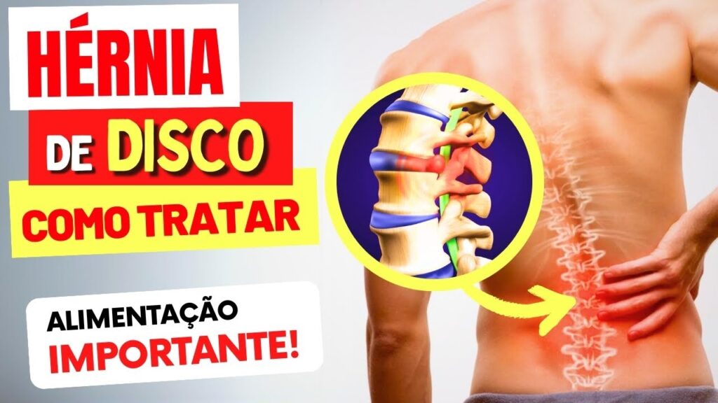 HÉRNIA DE DISCO – SINTOMAS, Como TRATAR e ALIMENTOS IMPORTANTES ...
