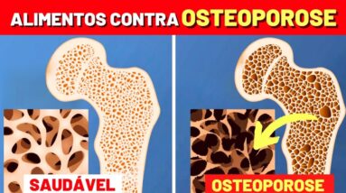 Melhores ALIMENTOS CONTRA OSTEOPOROSE e Como USAR!