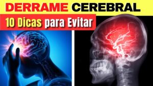 10 Dicas IMPORTANTES para evitar o DERRAME CEREBRAL! Como prevenir o AVC?