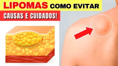 LIPOMAS (Bolas de Gordura) - Causas, Sinais e COMO EVITAR - Alimentação e Cuidados Importantes