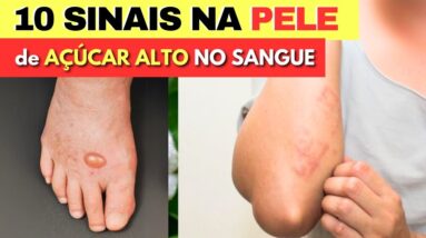 10 SINAIS na PELE de AÇÚCAR NO SANGUE ALTO (Pré-Diabates e Diabetes) e Dicas