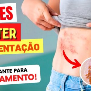 HERPES ZÓSTER - Alimentação CERTA no Tratamento e Sequelas