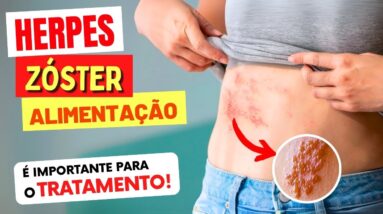 HERPES ZÓSTER - Alimentação CERTA no Tratamento e Sequelas