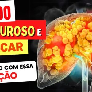 FÍGADO GORDUROSO e AÇÚCAR: A Relação que Pode Arruinar sua Saúde!