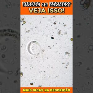Virose ou Vermes? Veja Isso!