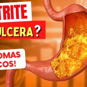 GASTRITE VIRA ÚLCERA? Sintomas e Riscos que Você Precisa Conhecer